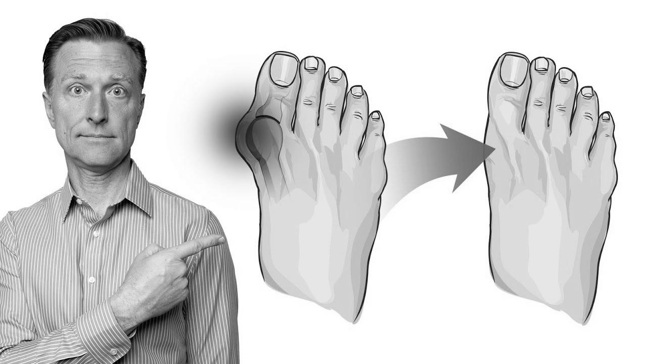 Easy methods to Repair Bunions in 3 Steps